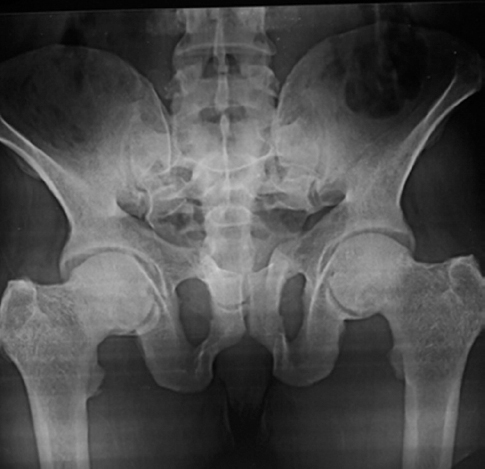 One-year after treatment: Improvement in bone density and healed fractures in pelvis.